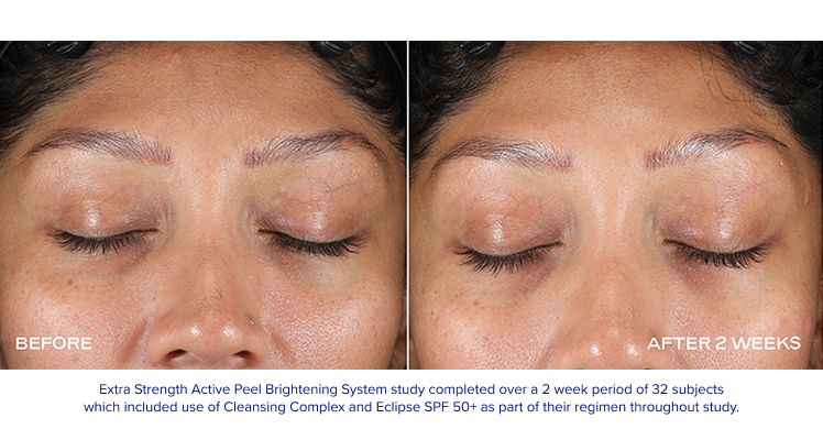 Extra Strength Active Peel Brightening System